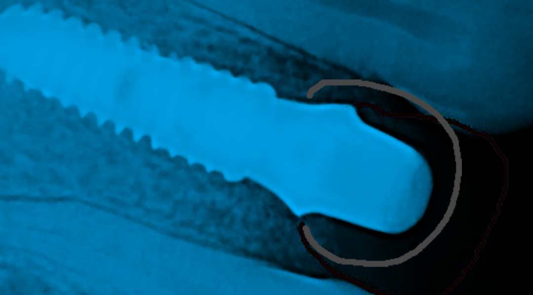 Dental Implants Case Study.