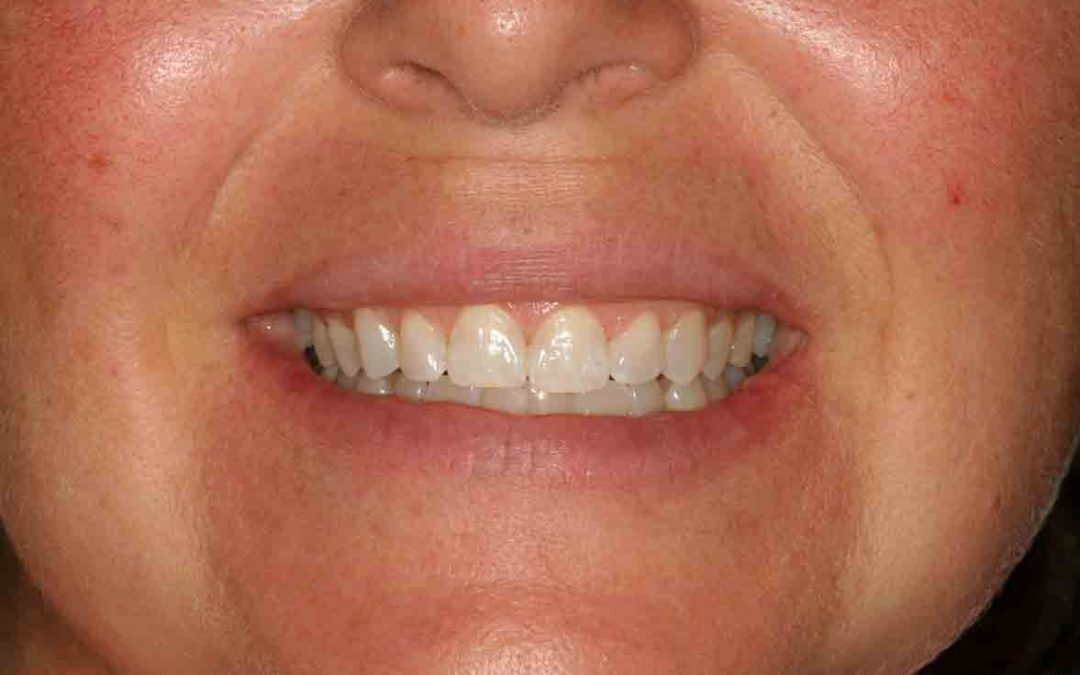 Zoom in- office teeth whitening.