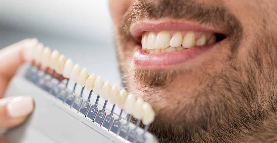 Replacing Old Veneers When Your Smile MakeOver Needs a MakeOver Natural Dentistry Maple